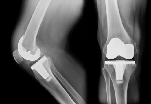 Total Joint Replacement
